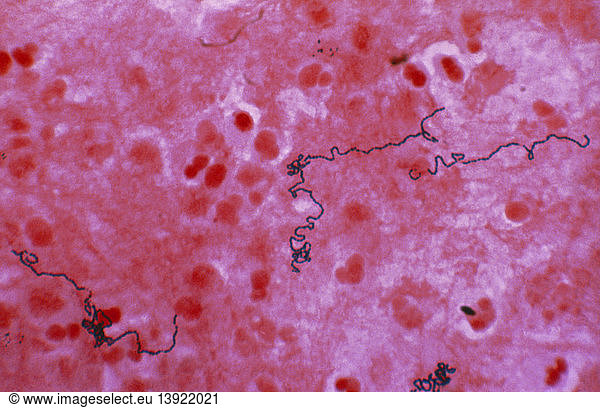 Streptococcus in Pus Streptococcus in Pus,bacilli,bacterial infection ...