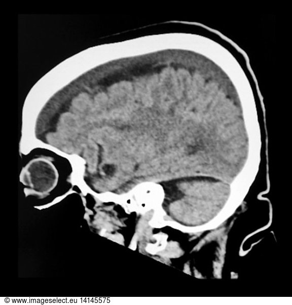 Subacute Subdural Hematoma On Ct Subacute Subdural Hematoma On Ct