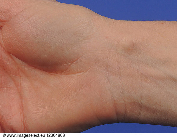 Synovial Cyst Of The Wrist Synovial Cyst Of The Wristbenigncystoiddermatologicneoplasia