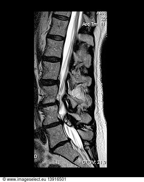 Synovial Cyst with Spinal Stenosis Synovial Cyst with Spinal Stenosis ...