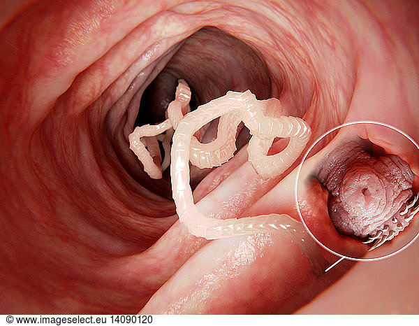 Tapeworm in human intestine