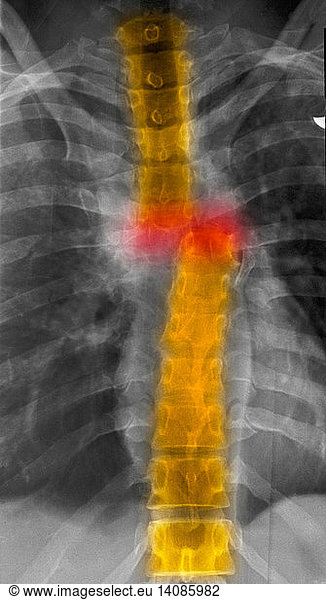 Thoracic Spine Fracture Thoracic Spine Fracture, X-Ray,colorised ...