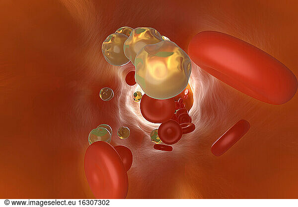 Three dimensional render of cholesterol clogging vein
