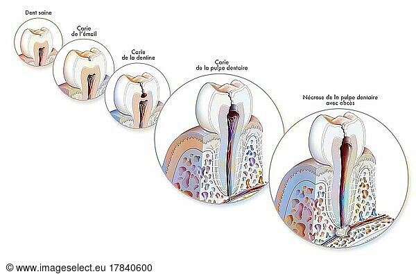 Tooth Formation And Development Of Dental Caries Tooth Formation And Development Of Dental