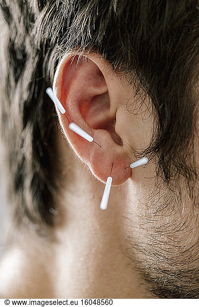 Traditional Chinese Medicine  TCM  acupuncture  ear with acupuncture needle during treatment