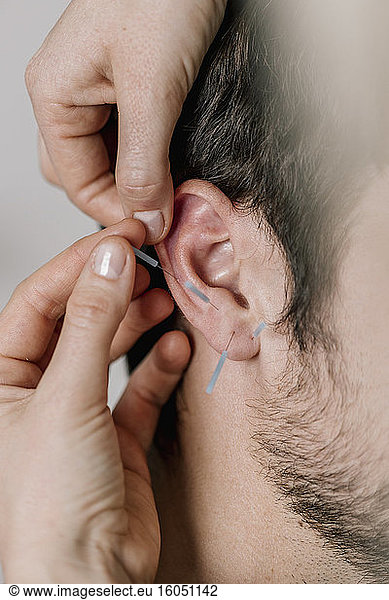 Traditional Chinese Medicine  TCM  acupuncture  ear with acupuncture needle during treatment