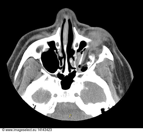 Trauma to Orbit Trauma to Orbit, CT Scan,abnormal ct of orbits,abnormal ...