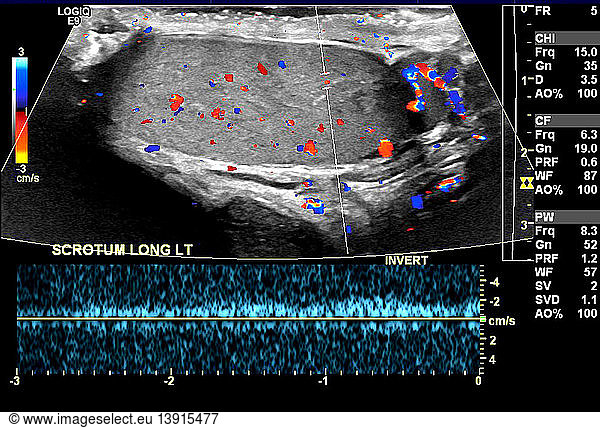 Ultrasound Of Normal Testicle Ultrasound Of Normal Testicle Color Flow Doppler Of Testicle