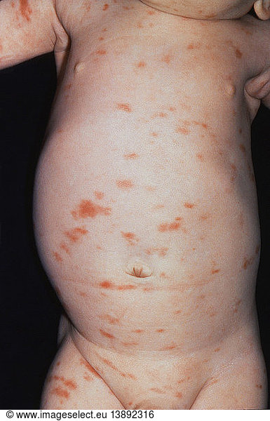 urticaria-pigmentosa-urticaria-pigmentosa-abnormal-abnormality-child