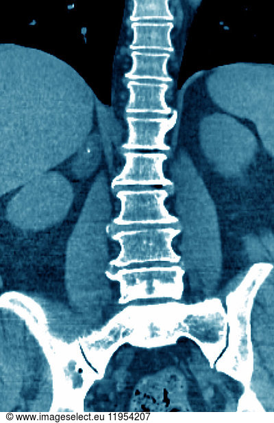 Vertebral Osteoarthritis With Osteophytes Bone Spurs Seen On A