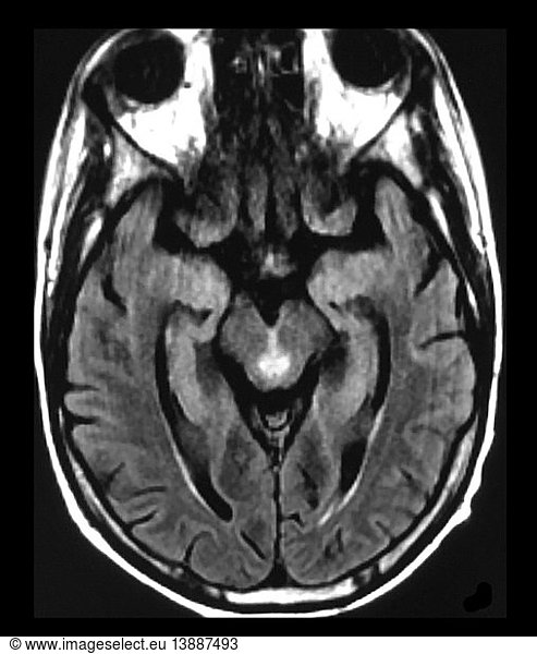 Wernicke's Encephalopathy on MRI Wernicke's Encephalopathy on MRI ...