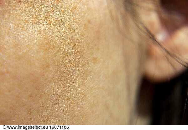 woman skin face with freckles