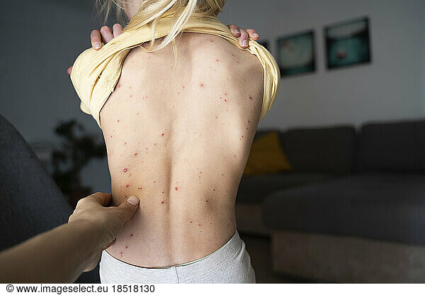 Woman touching back of girl with chickenpox