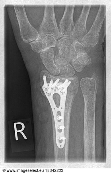 X-ray of a patient with a distal radial extension fracture on the right ...