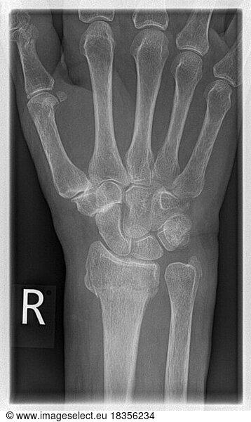 X-ray of a patient with a distal radial extension fracture on the right ...