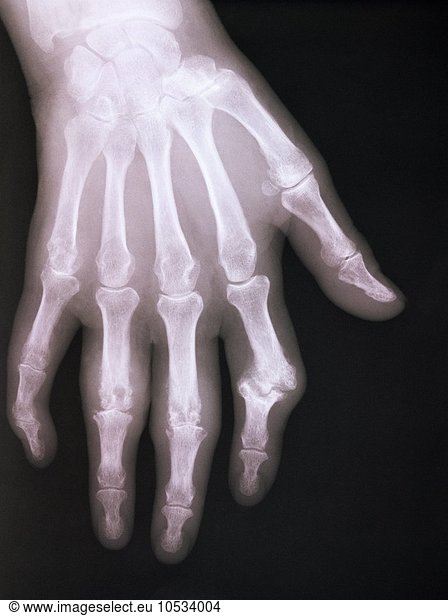 X-ray of arthritic hand
