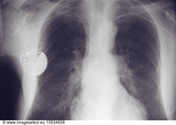 X-ray of chest showing pacemaker