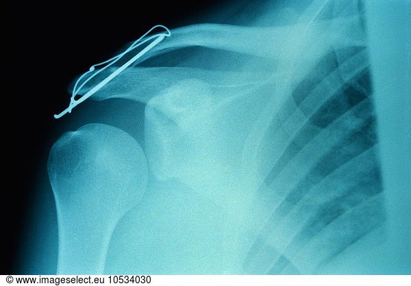 X-ray of damaged shoulder with wire