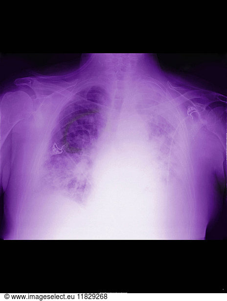 mesothelioma-of-fallopian-tube