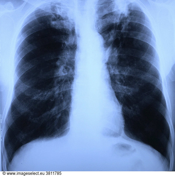 X-ray of lungs and thorax with upper lobes - tuberculosis on both sides ...