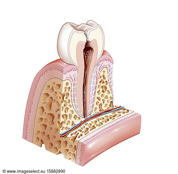 Zahnpathologie mit Karies  die die Pulpa erreicht. Die Pulpa ist der zentrale Bereich des Zahns  der Endodont. Sie ist hier rötlich-braun dargestellt. Sie wird auch Pulpakammer  Koronarpulpa oder Kameralpulpa für den zentralen Teil der Krone genannt. Der zentrale Teil in der Wurzel wird als Wurzelpulpa bezeichnet. Hier befinden wir uns im Stadium 3 des Zahns  der von Karies befallen ist. Die Pulpa enthält die Gefäße und Nerven des Zahns und verleiht ihm seine Vitalität und Empfindlichkeit. Wenn sie von Karies befallen ist  löst sie deshalb Zahnschmerzen aus.